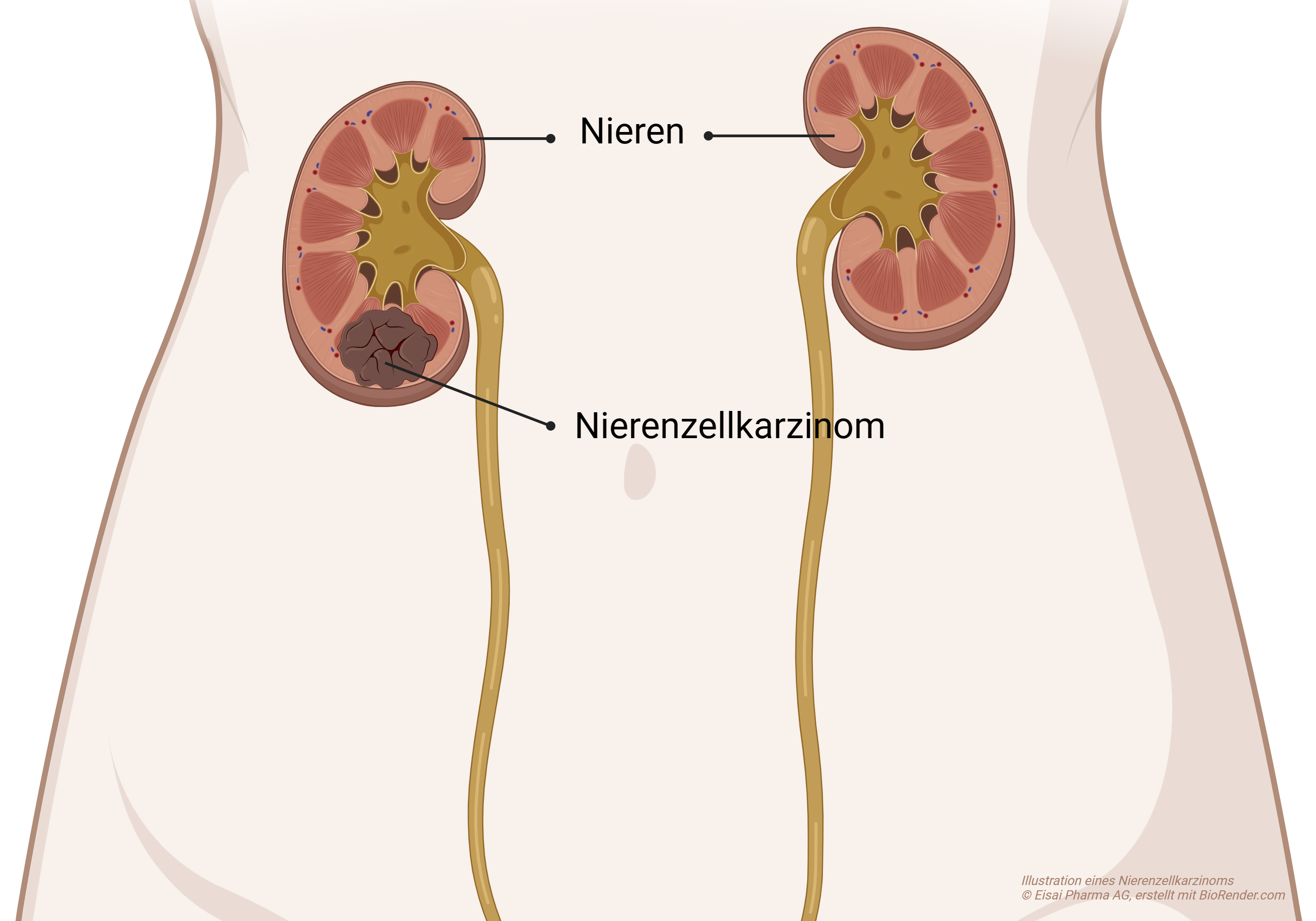 Nierenkrebs, auch bekannt als Nierenkarzinom, Nierenzellkarzinom oder Adenokarzinom der Niere, ist eine Tumorerkrankung der Niere.